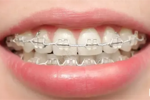 ems喷砂洁牙是什么（ems洁牙机的使用方法）(图1)